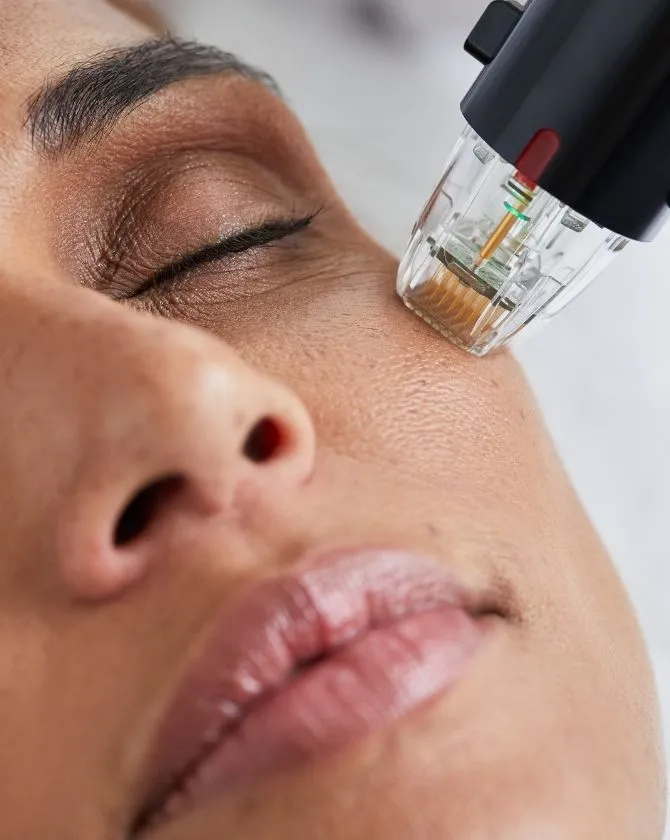 Microneedling